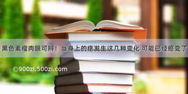 黑色素瘤肉眼可辨！当身上的痣发生这几种变化 可能已经癌变了